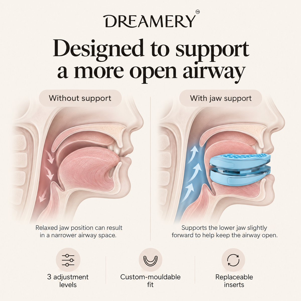 Dreamery AirFit Adjustable Anti-Snore Device
